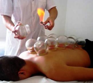 Dry Cupping