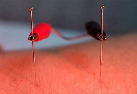 ELECTRO-ACUPUNCTURE