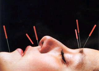 ACUPUNCTURE-FACE